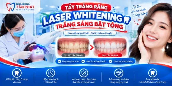 Tẩy Trắng Răng Công Nghệ Laser Whitening – Trắng Sáng Bật Tông, Tự Tin Nụ Cười